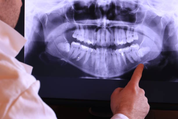 Best Emergency Wisdom Tooth Extraction in Alice, TX
